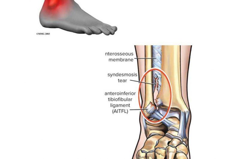 Ankle Syndesmosis