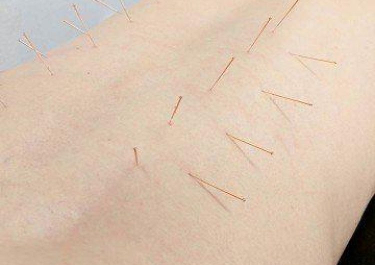 Clinical Acupuncture