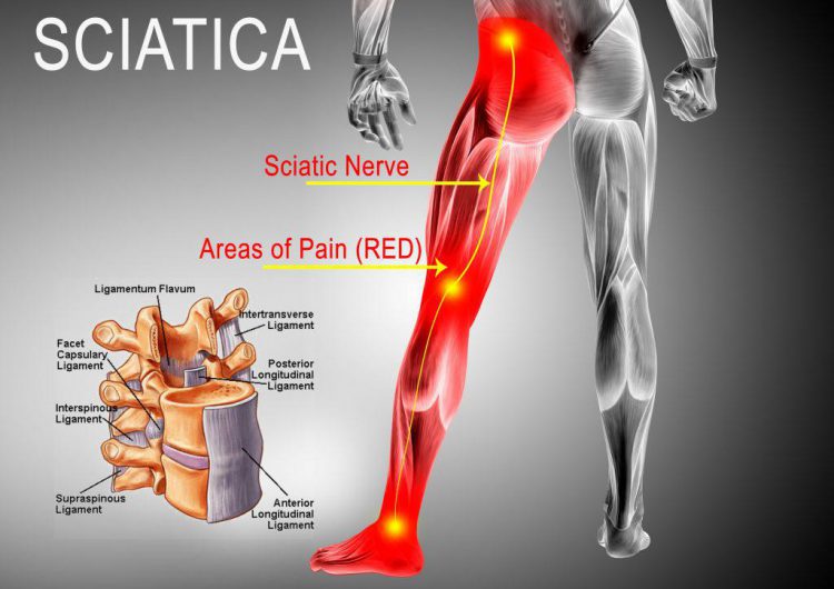 Sciatica