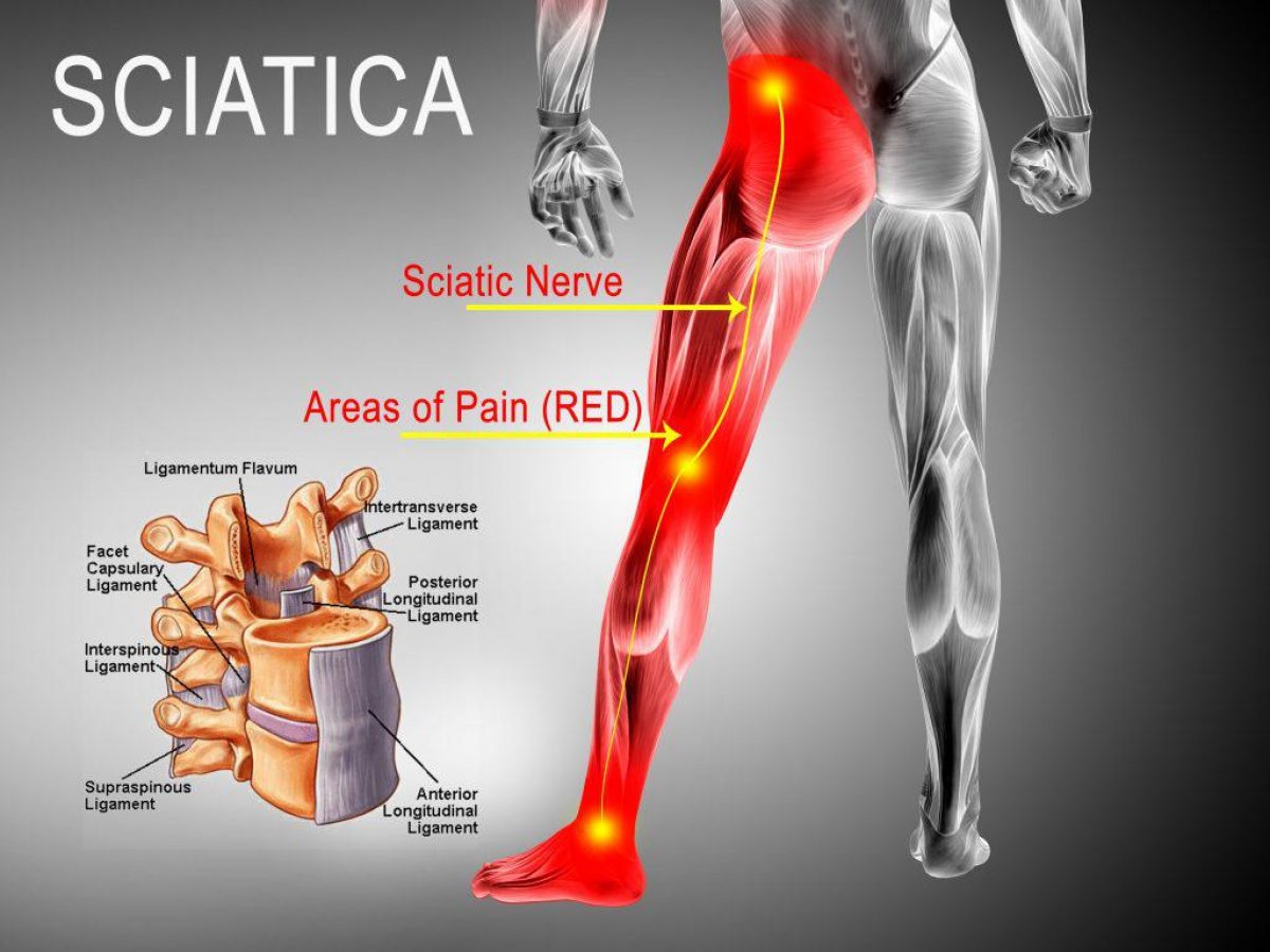 Sciatic pain diagram 1024x768
