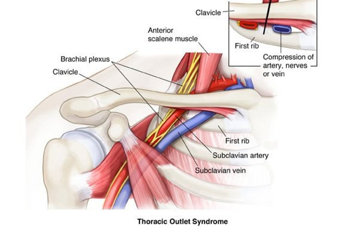Thoracic outlet syndrome 1
